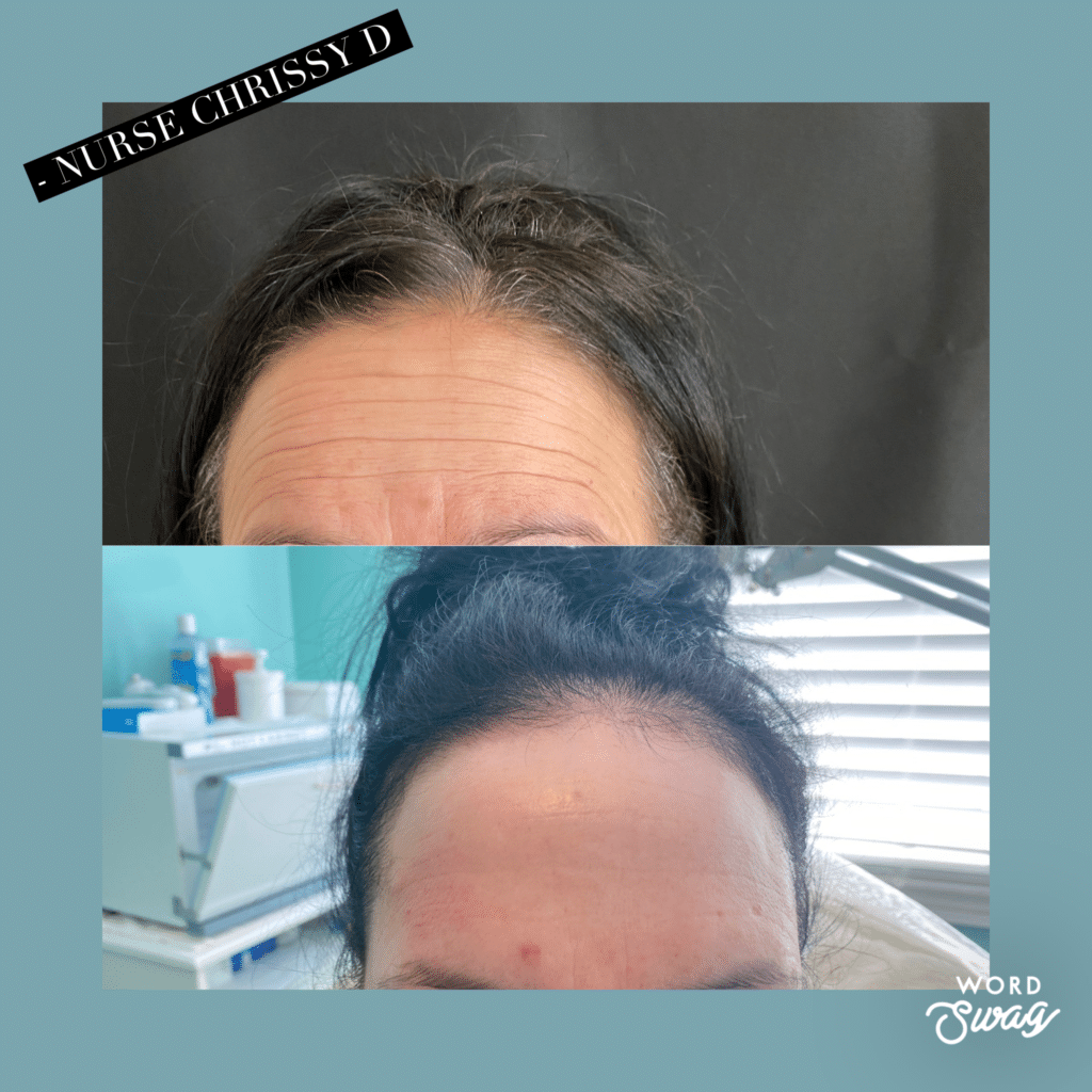 Before and After Image: Botox - front