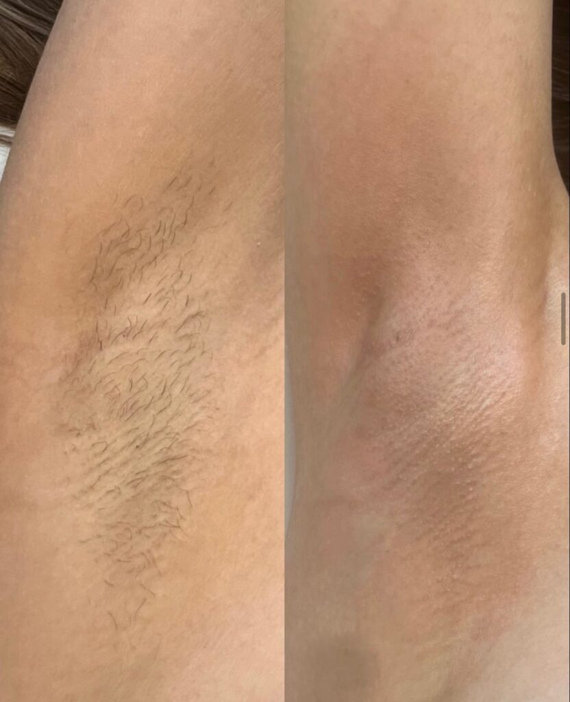 Before and After Image: Laser Hair Removal – Underarms - front