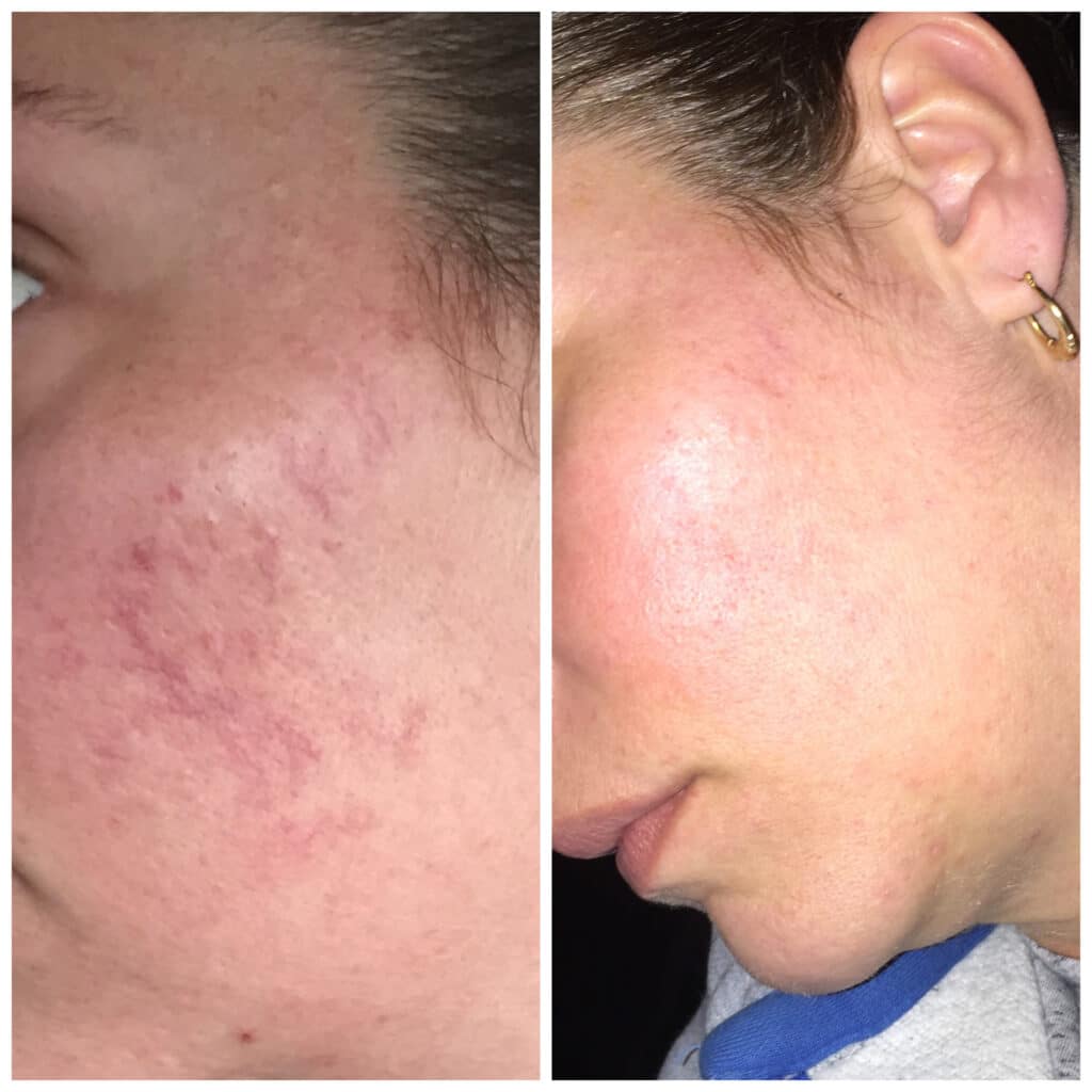 Before and After Image: Facial Vein Treatment - left-front-oblique