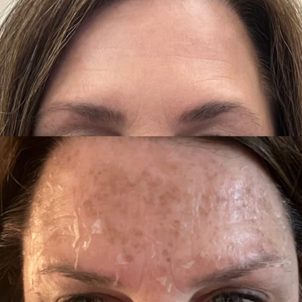 Before and After Image: Chemical Peel - front