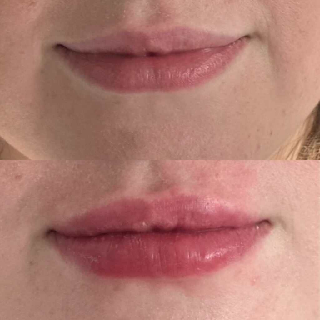 Before and After Image: Lip Filler - front
