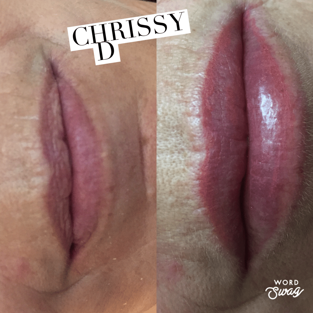 Before and After Image: Lip Filler - front
