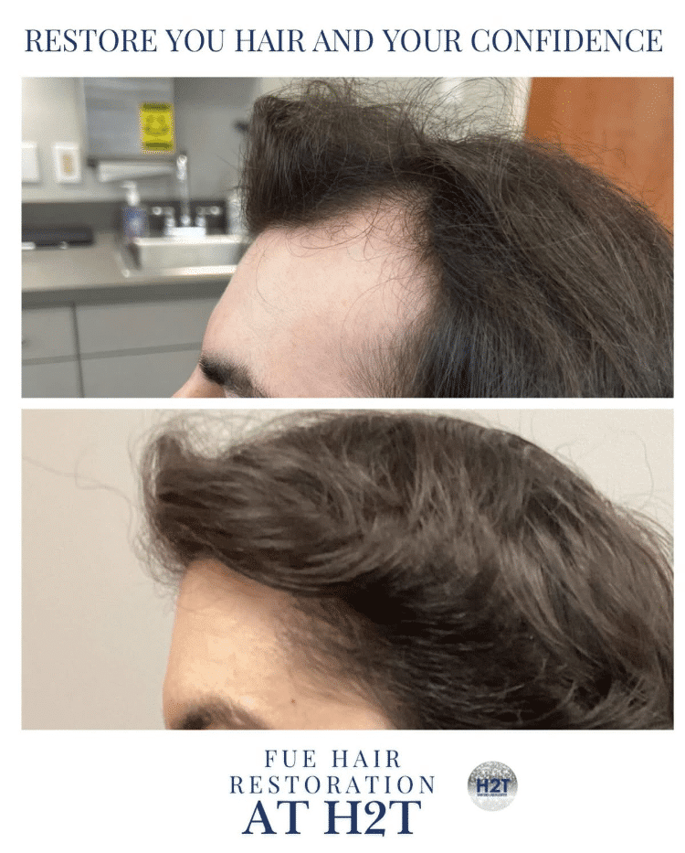 Before and After Image: Fue Hair Restoration - left-side