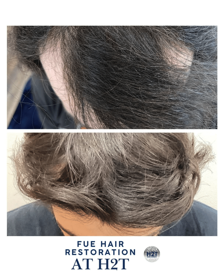 Before and After Image: Fue Hair Restoration - front