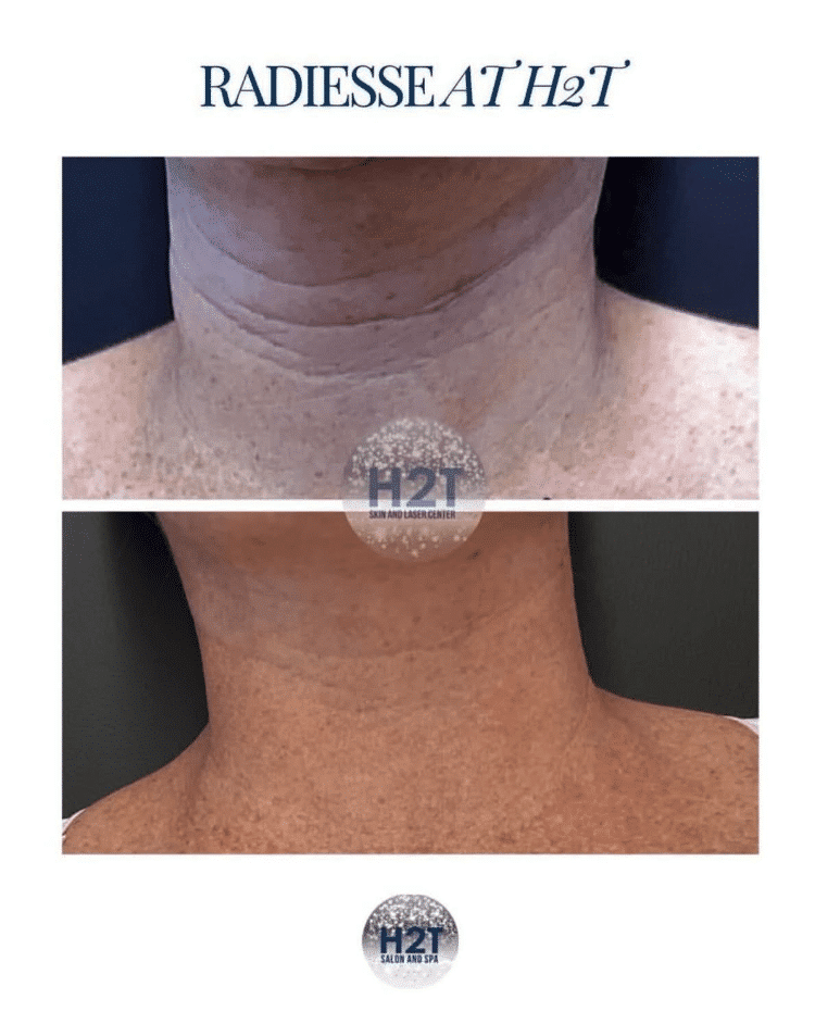 Before and After Image: Radiesse - front