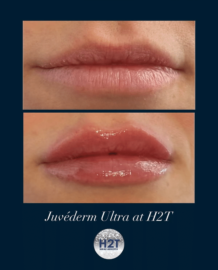 Before and After Image: Juvederm Ultra - front