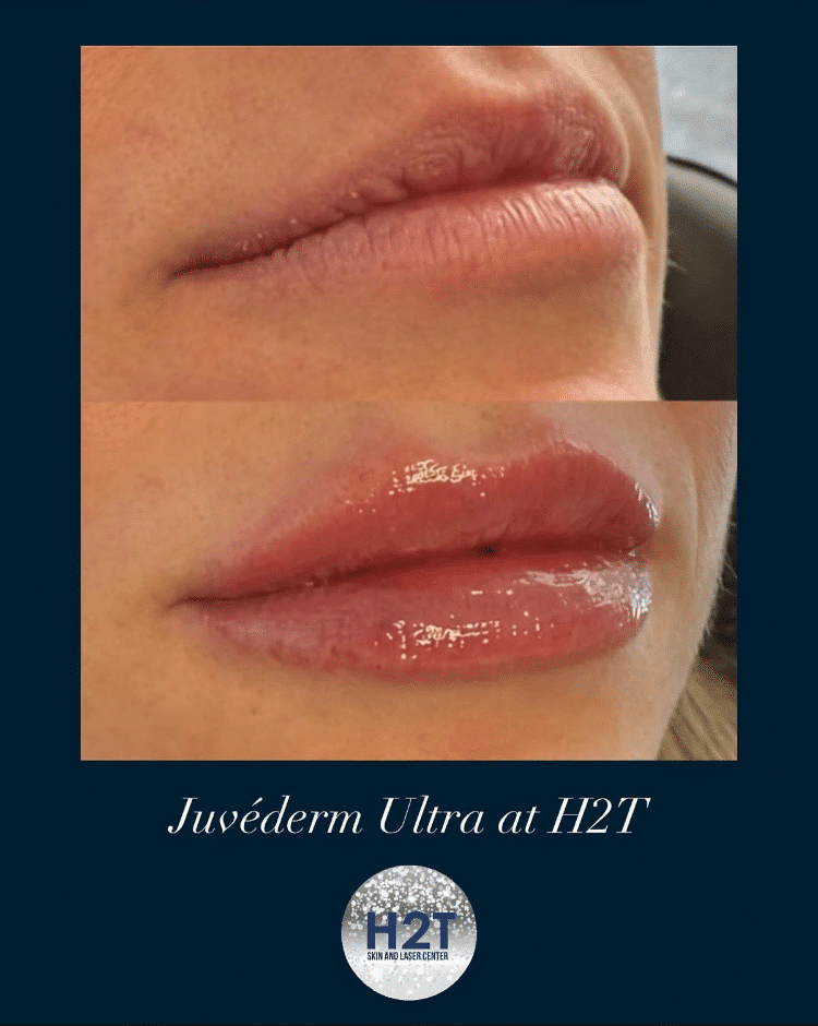 Before and After Image: Juvederm Ultra - right-front-oblique