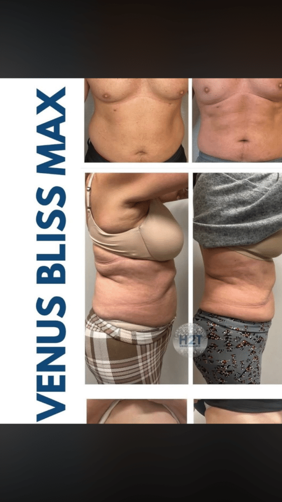 Before and After Image: Venus Bliss Max - right-side