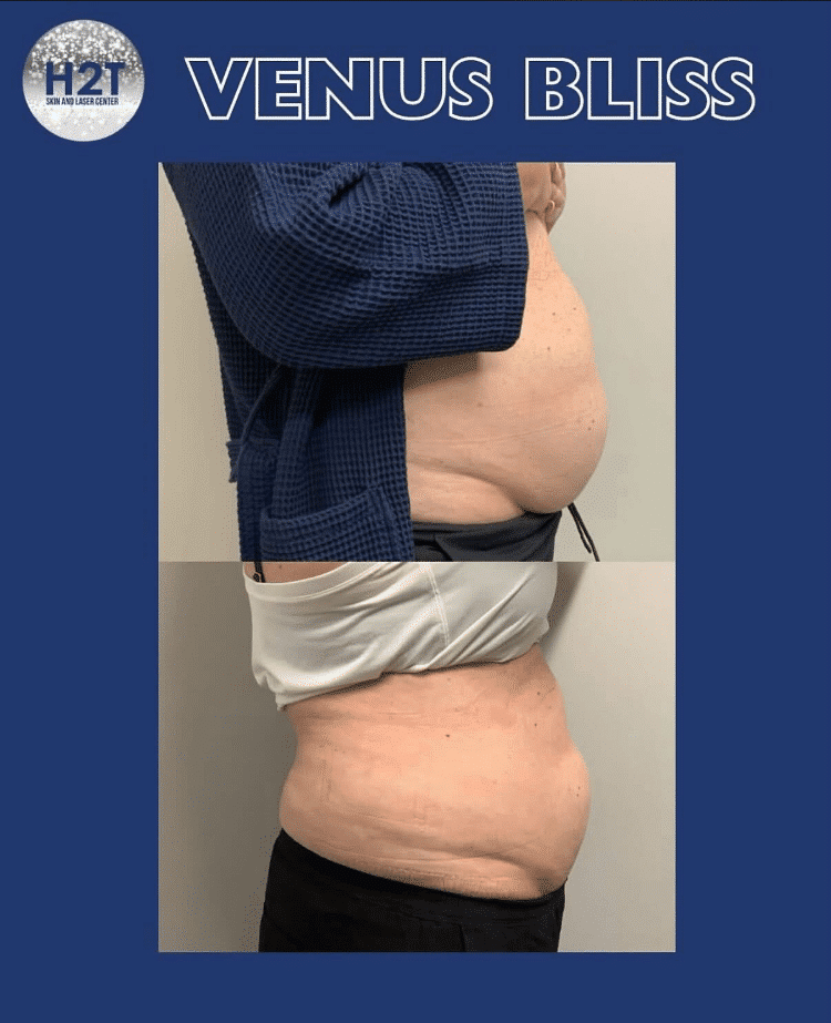 Before and After Image: Venus Bliss - right-side