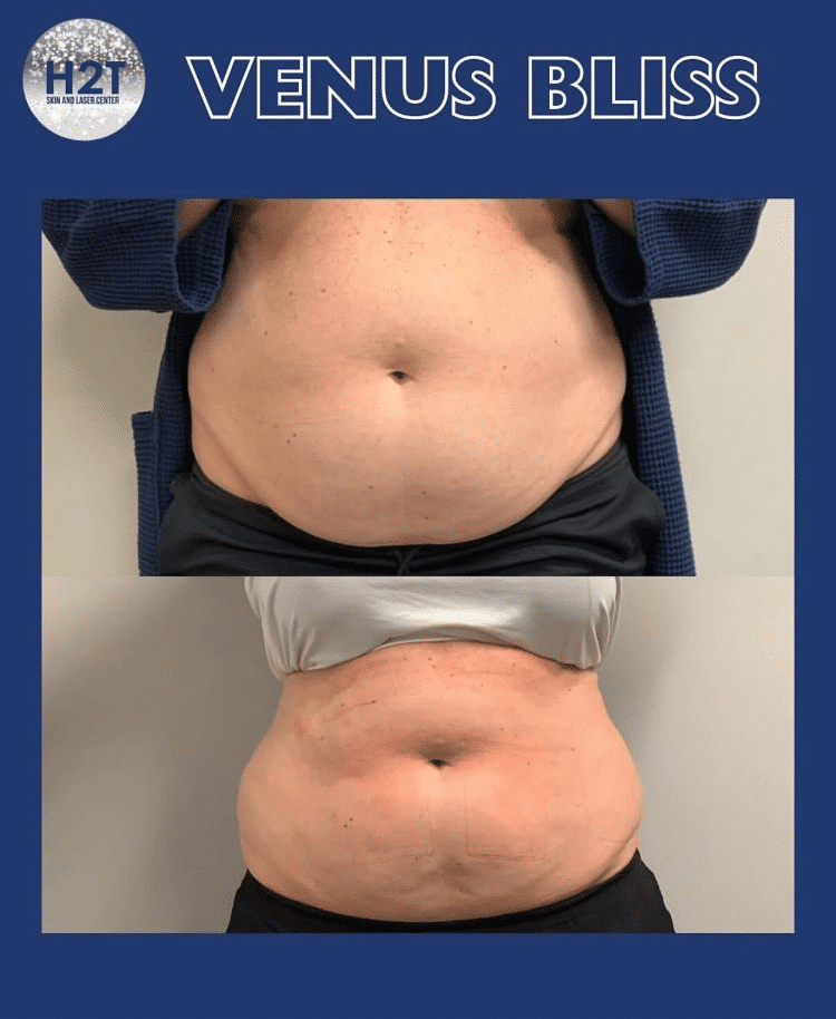 Before and After Image: Venus Bliss - front