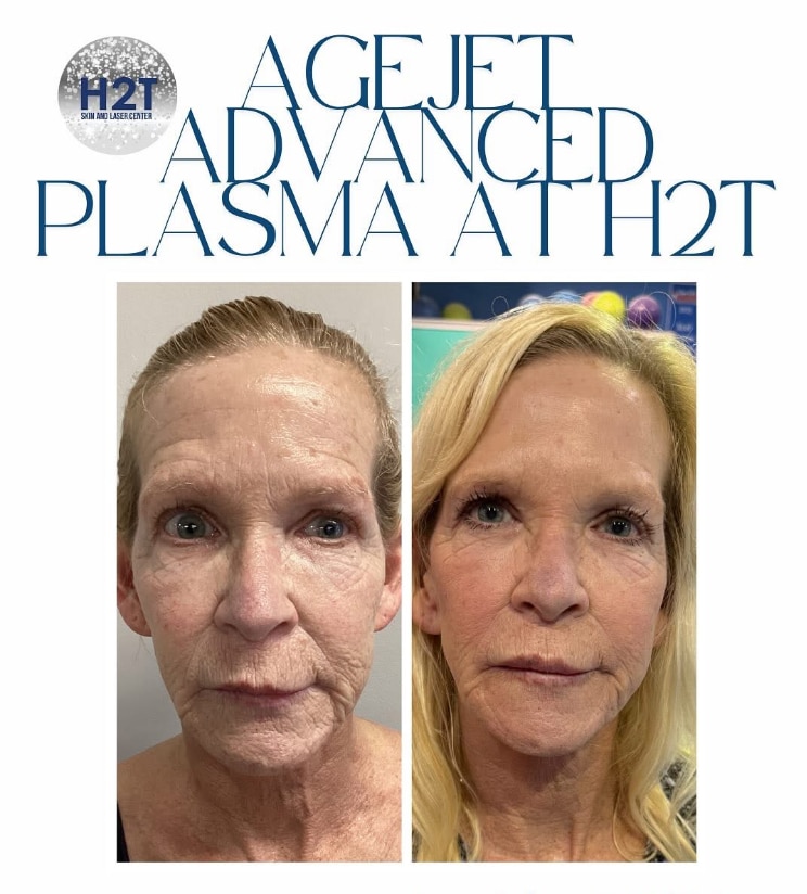 Before and After Image: Agejet Advanced Plasma - front